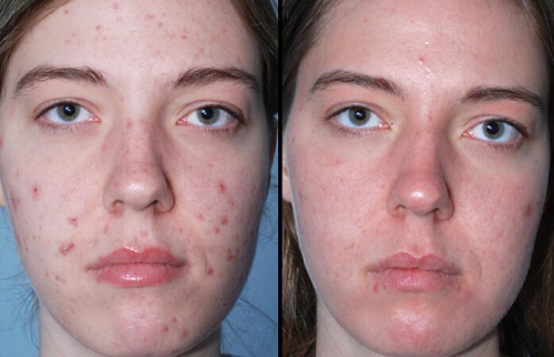 Peeling Químico